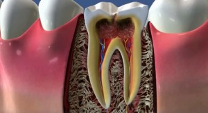  Пульпит   зубное воспаление